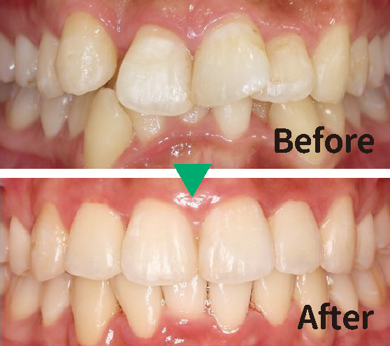 Case1. 前歯の矯正治療