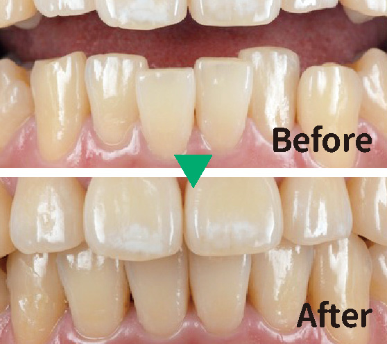 Case2. 前歯の矯正治療